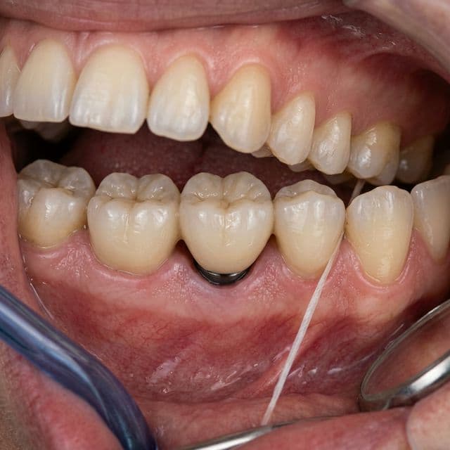 Permanent Teeth Replacement at Rosa Dental Center Elizabeth, NJ